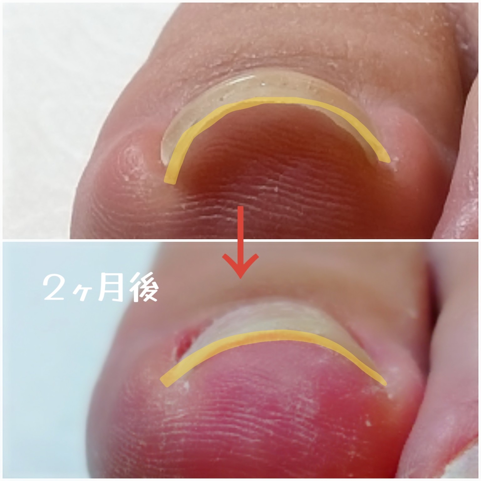 巻き爪ケア前後の経過例